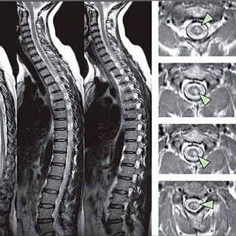 torasik osteokondroz tanısı